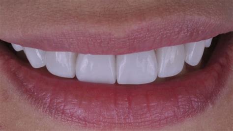 affordable dental veneers saint laurent